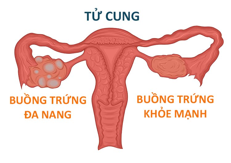 Hội chứng buồng trứng đa nang (PCOS) và tăng cân